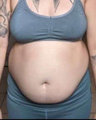 1. Excess Belly Fat or Apple-Shaped Body