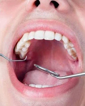 Dental Problems (Frequent Cavities, Gum Disease)