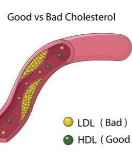 4. High Triglycerides and Low HDL Cholesterol