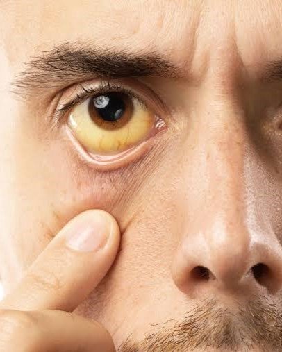 4. Jaundice: Yellowing of the Skin or Eyes