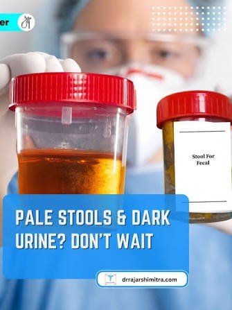 5. Dark Urine and Pale Stools