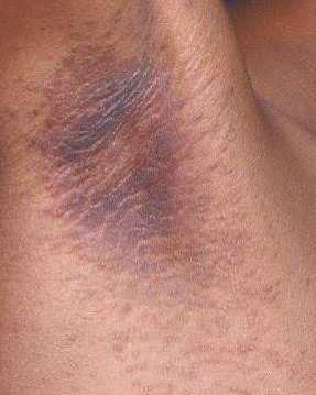 6. Dark, Velvety Skin Patches (Acanthosis Nigricans)