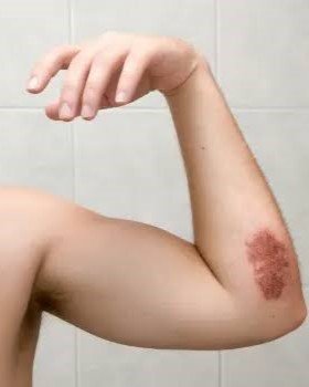 6. Slow-Healing Cuts, Bruises, and Frequent Infections