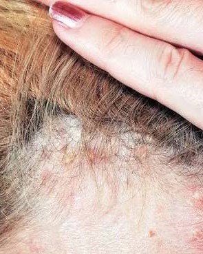 2. Skin (Scalp)