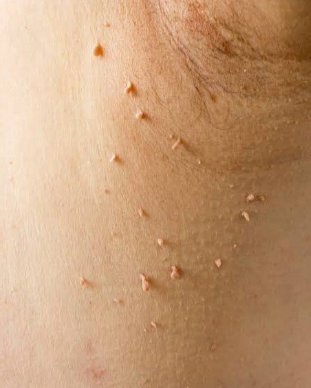7. Skin Tags