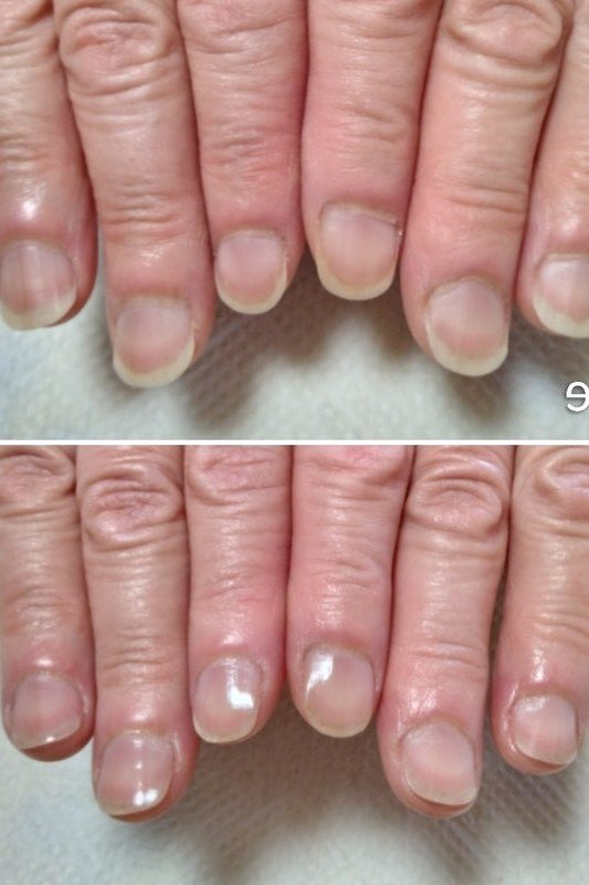 Tracking nail care progress on mature nails before and after