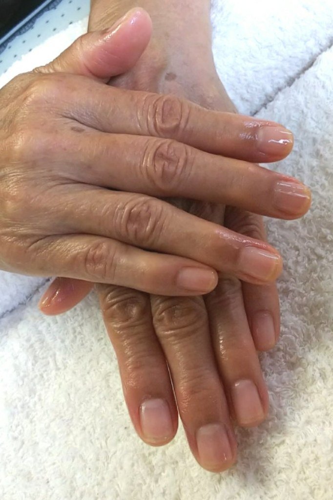 Filing mature nails gently without sawing