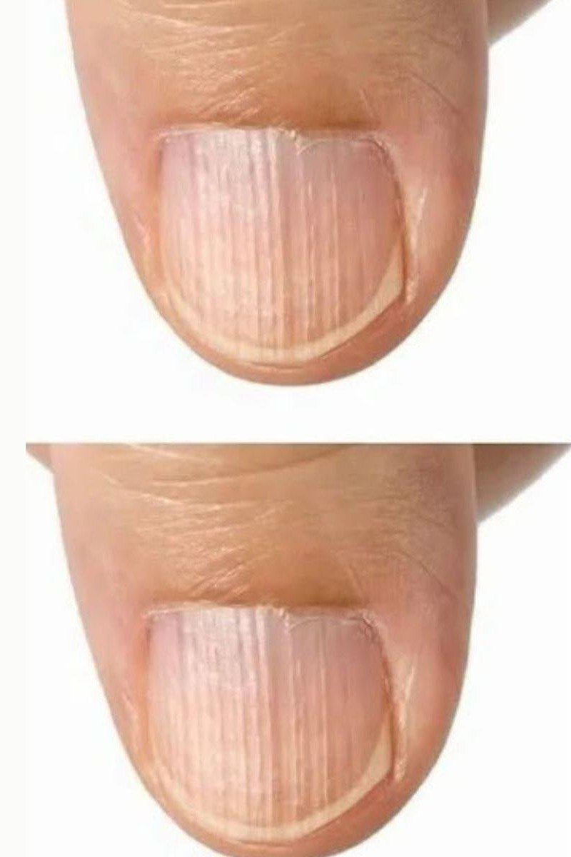 Gently buffing vertical nail ridges common after 50