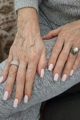 Elderly hands in gray sweater with milky white nails